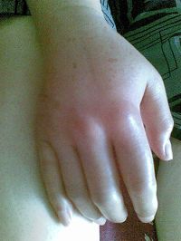 Опухшая рука Сюй Юйчжи