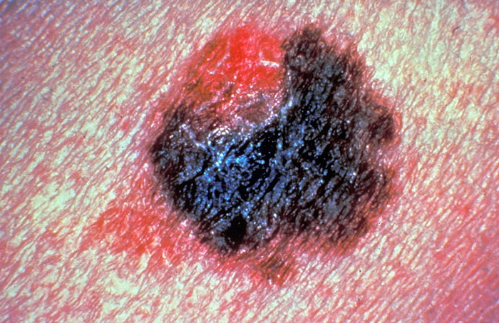 Мужчины умирают от меланомы чаще женщин. Фото: Cancer Society/Getty Images