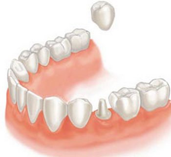 Один из способов имплантации зубов. Фото с сайта  https://intan.ru/implantatsiya/tseny/