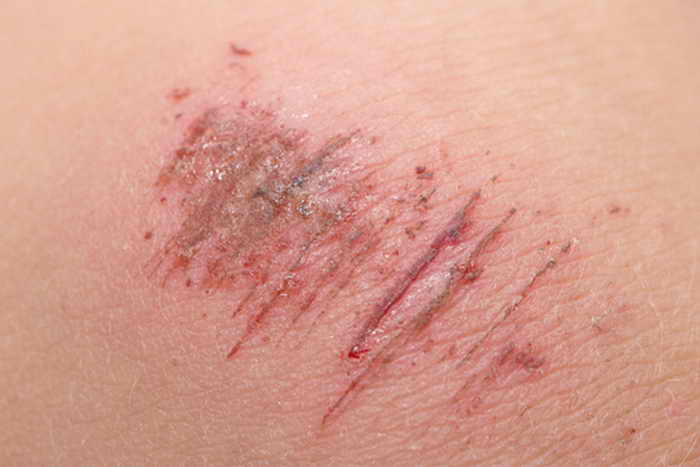 Рана. Фото: Shutterstock*