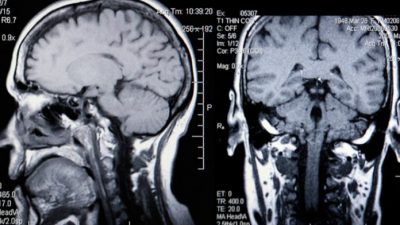 Исследователи находят всё больше доказательств того, что диабет влияет не только на тело, но и на мозг. Katrina Brown via Dreamstime 
