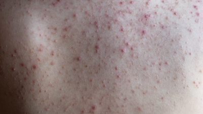 Зимой прыщи на спине можно хотя бы спрятать, но они доставляют неудобство, и вы постоянно о них помните. Фото: Chechotkin via Dreamstime 