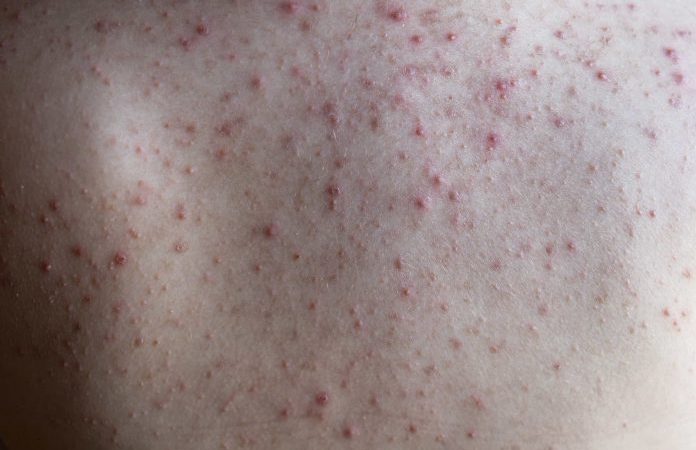 Всё, что нужно знать, чтобы избавиться от прыщей на спине Зимой прыщи на спине можно хотя бы спрятать, но они доставляют неудобство, и вы постоянно о них помните. Фото: Chechotkin via Dreamstime