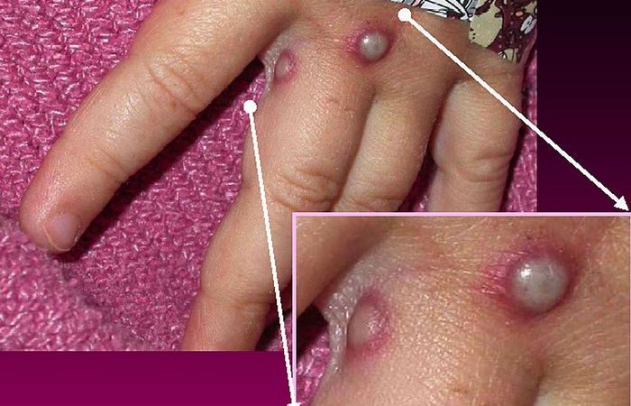 Бельгия первая в мире ввела карантин для заболевших оспой обезьян Бельгия первая в мире ввела карантин для заболевших оспой обезьян. (Photo Courtesy of CDC/Getty Images)